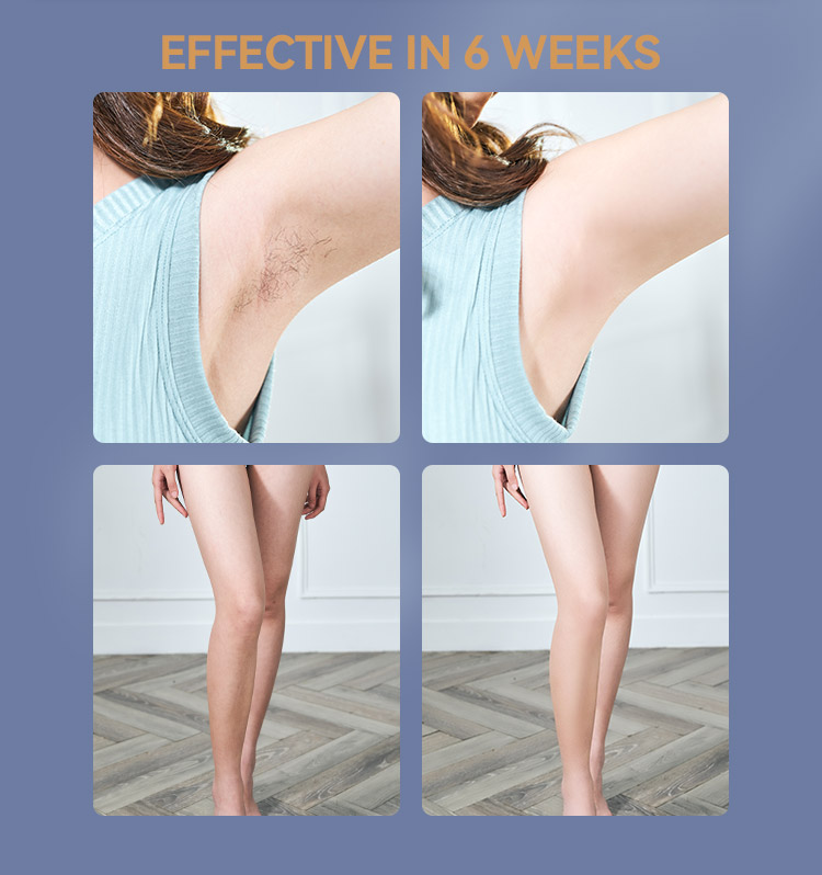 SKB-1808 Home-Use Portable IPL Hair Removal Device