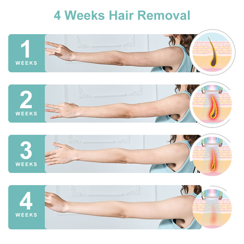 SKB-2008 Home-Use IPL Hair Removal Device