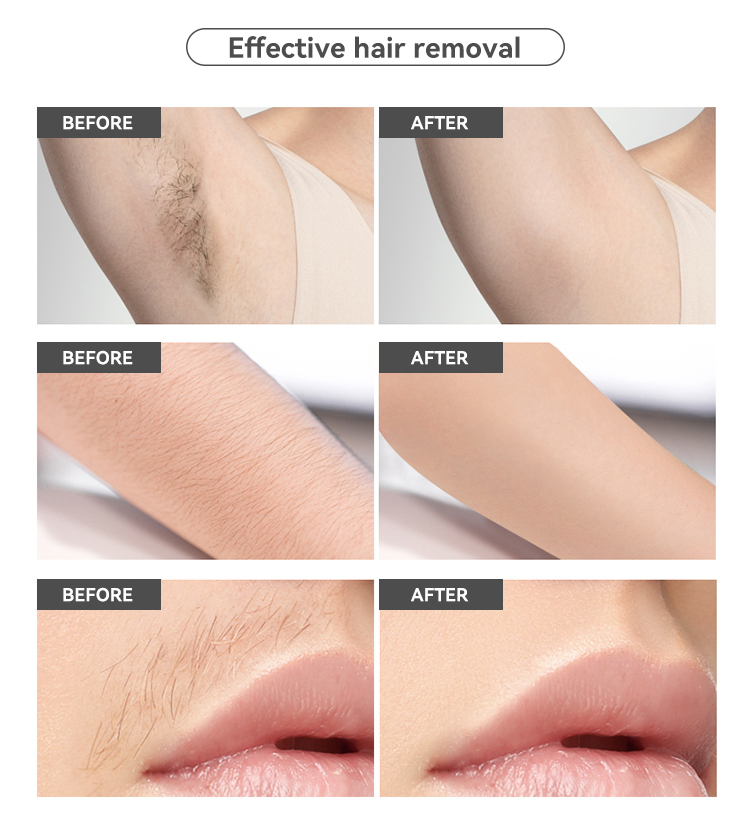 SKB-2118 Portable Ice-Cooling IPL Hair Removal Device